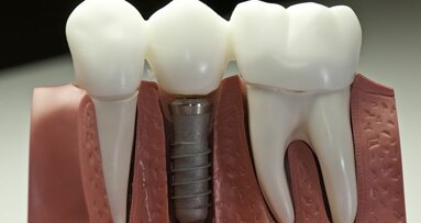 Dreptul de a insera implanturi dentare