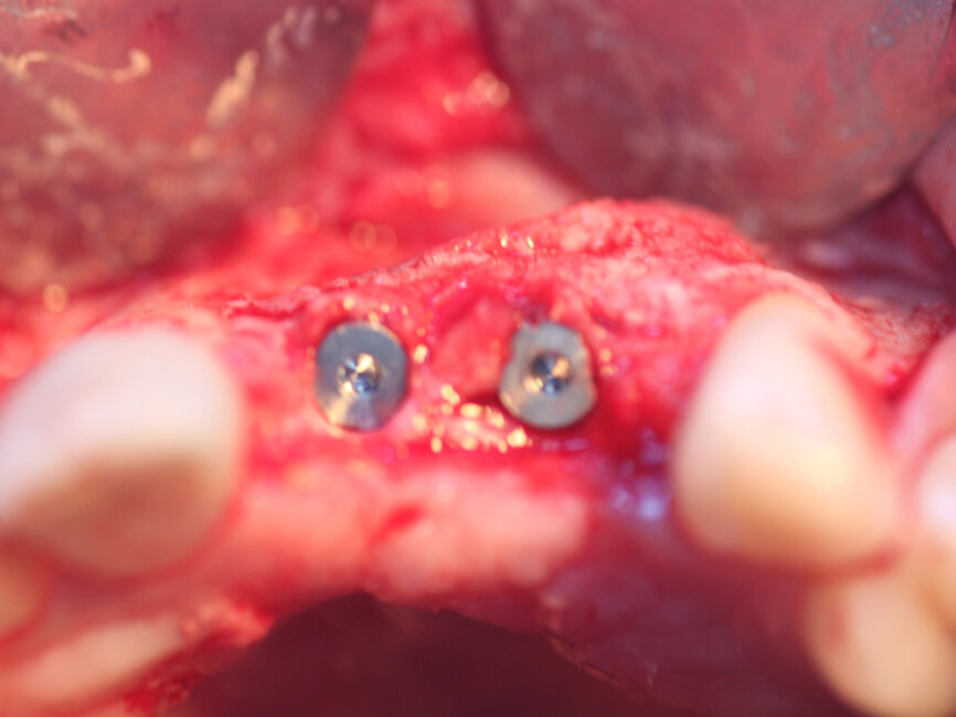 Fig. 18: Implants have been placed into the grafted previously deficient ridge showing adequate bone to house the implants and a lack of dehiscence on the facial aspect, shown prior to flap closure.