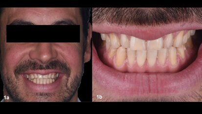 An aesthetic, minimally invasive restoration using a fully digital workflow