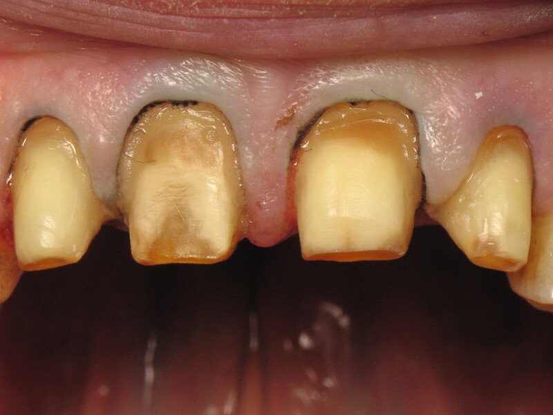Fig. 9 : Vue rapprochée de la préparation dentaire et de la rétraction gingivale