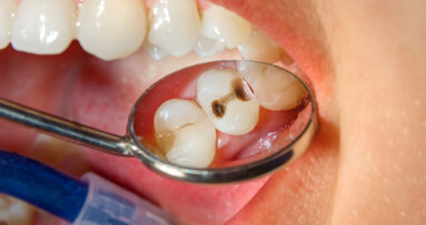 Human immune system contributes to dental caries and damage to dental fillings