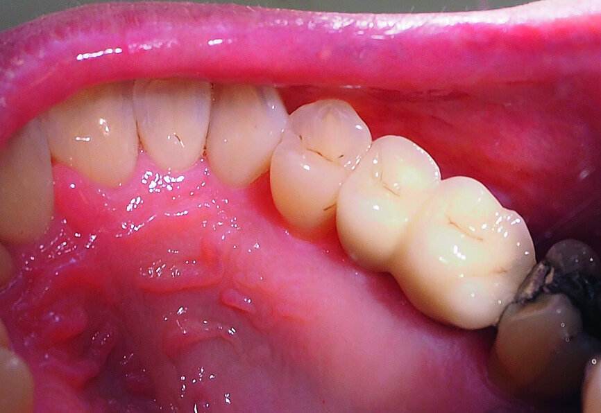 Fig. 23: Linked Lava zirconia crowns after cementation.