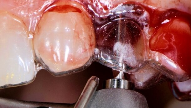 Alternatywne leczenie implantoprotetyczne przy wrodzonej hipodoncji siekaczy
