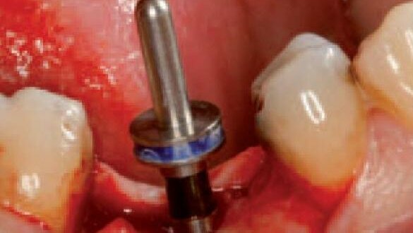 Zastosowanie implantu C1 – opis przypadku