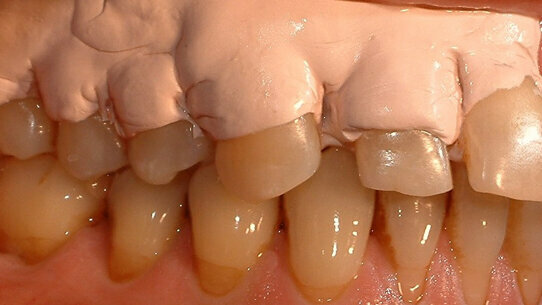 L’applicazione dell’impacco parodontale nel trattamento parodontale non chirurgico