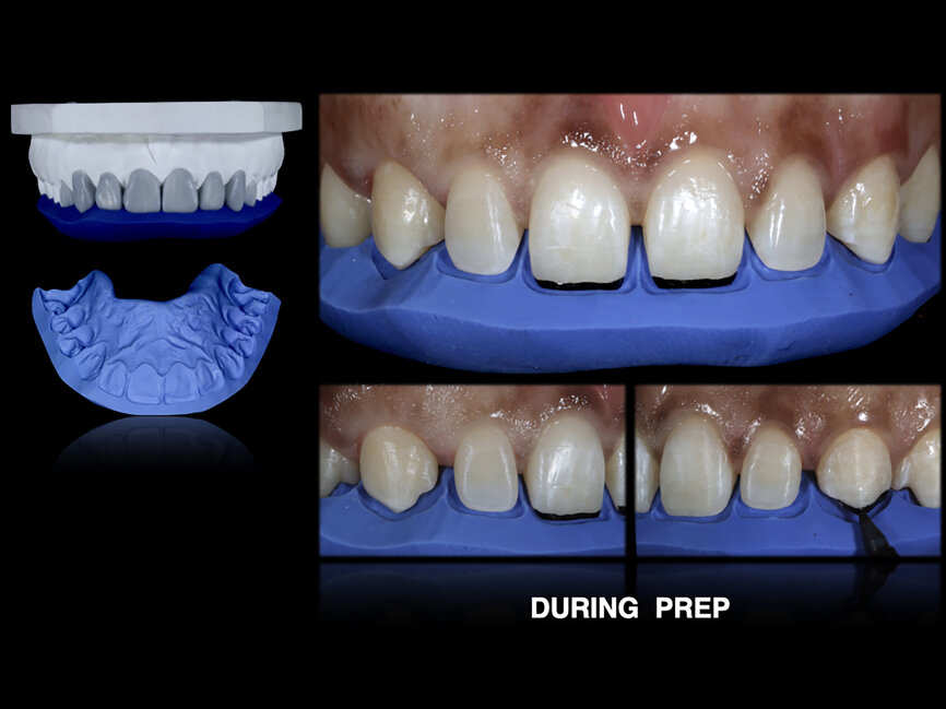 Fig. 53: The palatal-incisal
silicone index was used to establish the space on the incisal margin. Steps before, during and after preparation.