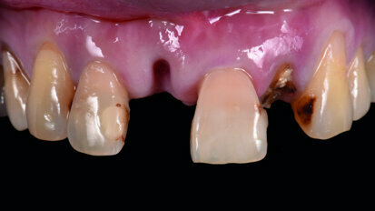 Immediate implantation with CAD/CAM and functional restoration in the aesthetic zone