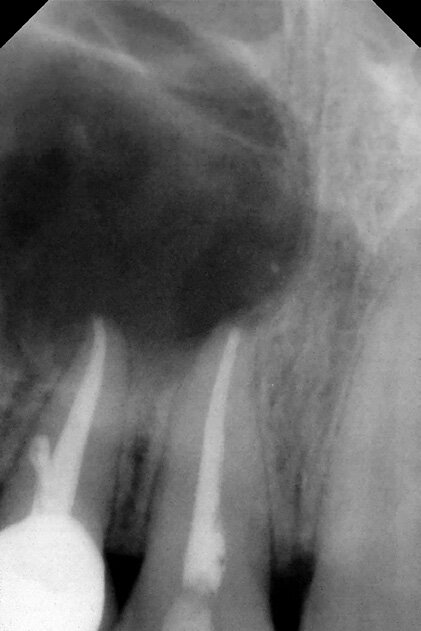 Figure 20: Periapical X-ray showing a 1.5 cm radiolucent lesion extending on apexes of teeth no 7 and 8 , note the lateral perforation on tooth no 7.