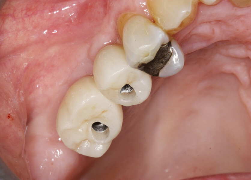 Fig. 15: Well-fitting screw-retained Atlantis CustomBase abutments and zirconia crowns tried in.