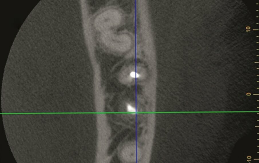 Fig. 1l–n: Two-year follow-up CBCT scan, axial (l), …