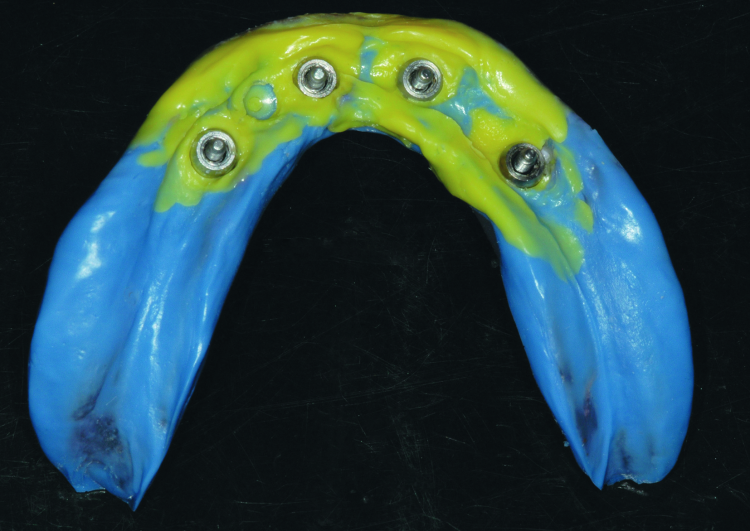 Fig. 5: Completed final impression using the custom tray and light body and medium body PVS, as well as rigid bite registration material around the impression copings to eliminate any movement of the copings.