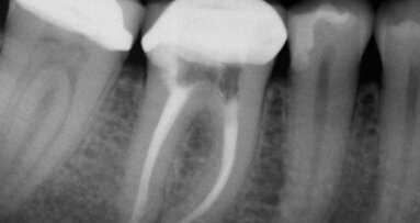 Rewizja leczenia endodontycznego – jak osiągnąć sukces przy drugim podejściu