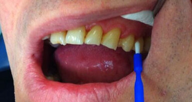 Trattamento dell’ipersensibilità dentinale
