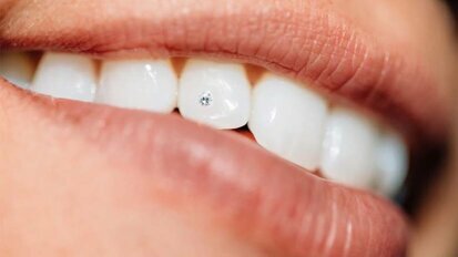 The Cosmo-Dentist Makes Smiles Sparkle With Tooth Jewel