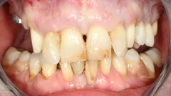 Partial extraction therapy and implant treatment in the maxilla