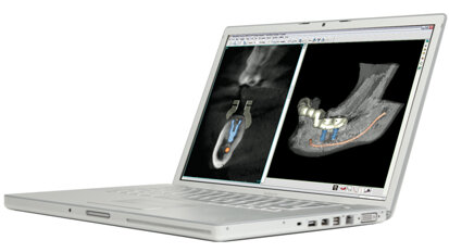 Materialise Dental unveils new software for implant treatment planning, plus online collaboration tool
