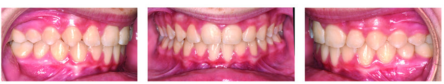 Fig. 7b. Patient S.V.’s post finished in 11 months with the Damon Ultima System.