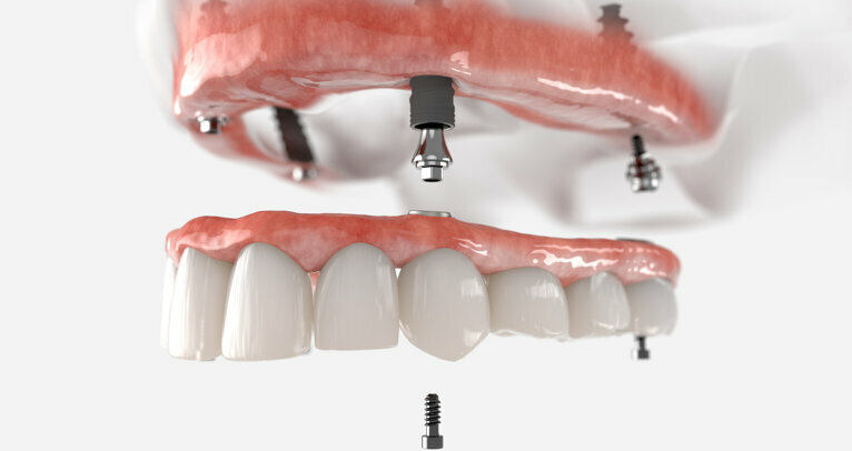 The Ankylos-SynCone Overdenture System: The biology, diagnosis and ...