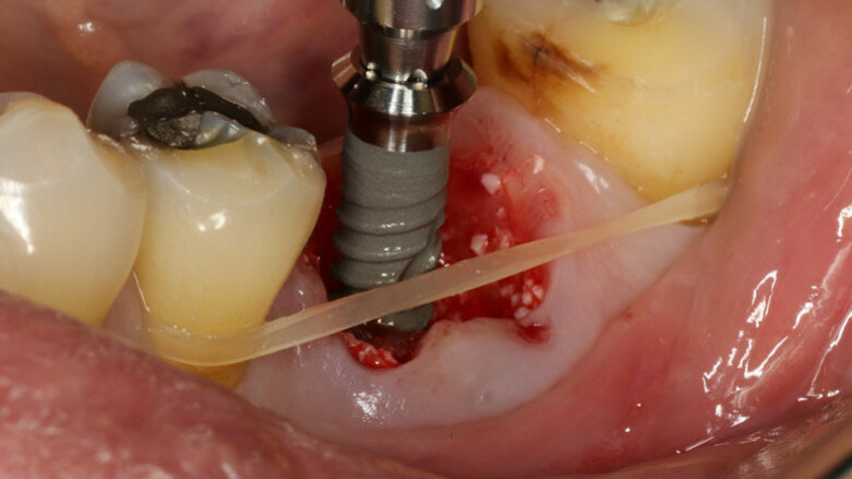 Straumann TLX: Immediate placement and loading in mandibular first molar position with follow-up