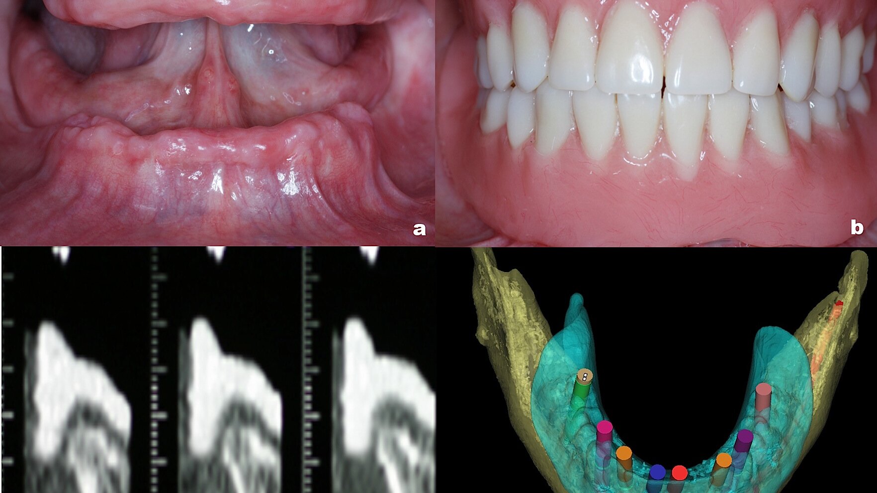 Principios De La Planificación Digital En Implantología Oral 7967