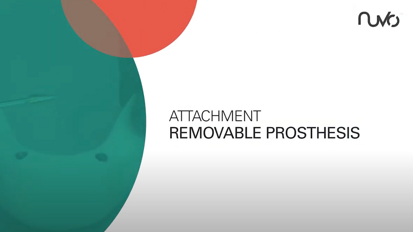 ConicalFIT attachment Removable Prosthesis