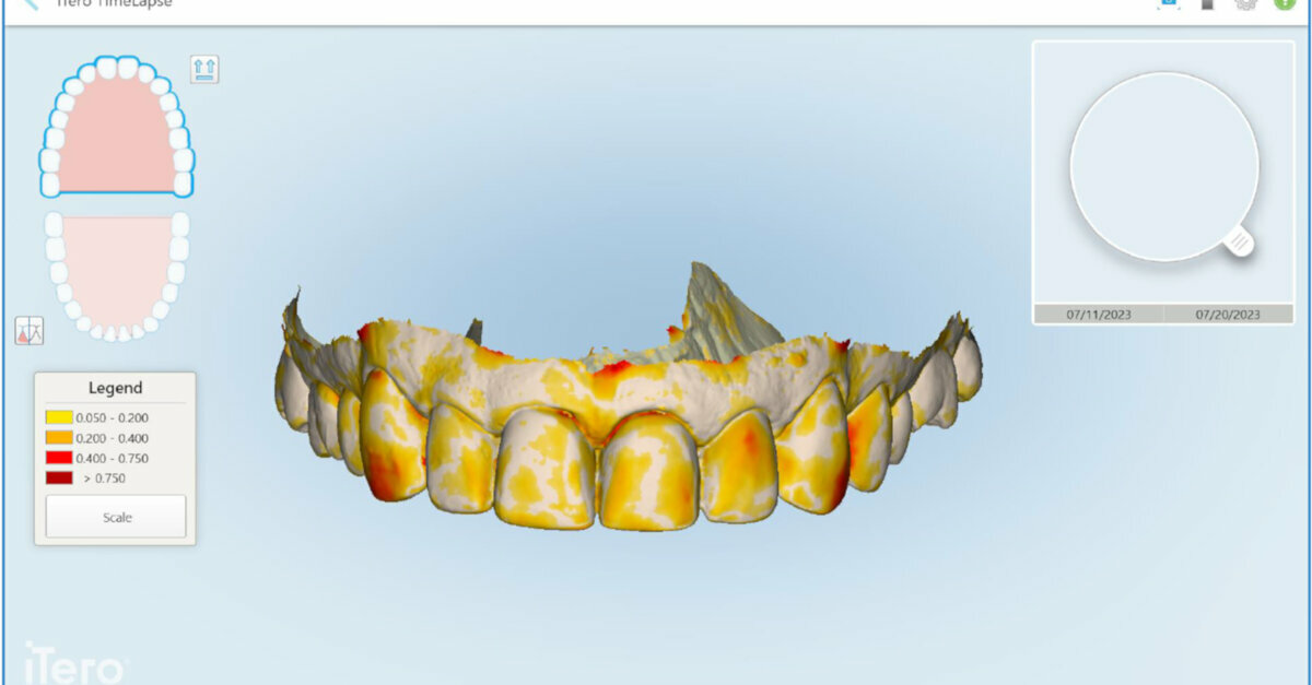 Digital scan reassures patient in veneer treatment