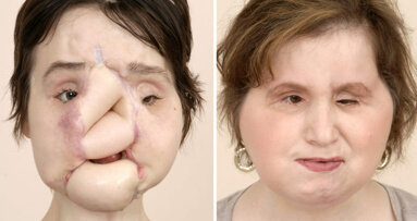 Young woman receives successful face transplant