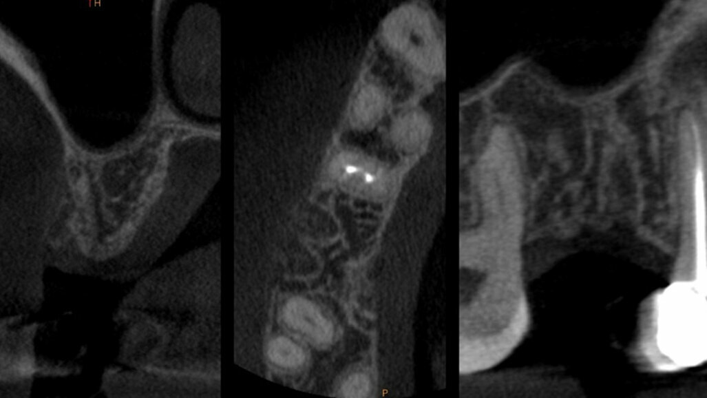 Preservazione della cresta ossea mediante tecnica di Inibizione Periostale Modificata: un caso pilota