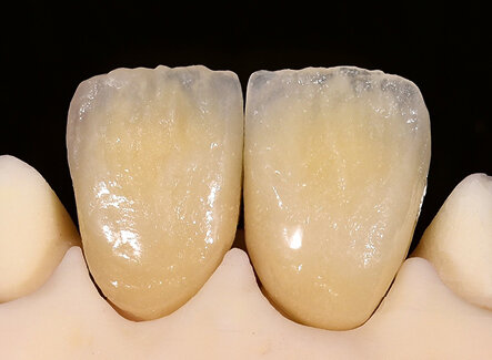 Fig. 13: The two anterior crowns after the corrective firing (left: IPS d.SIGN; right: IPS Style)
