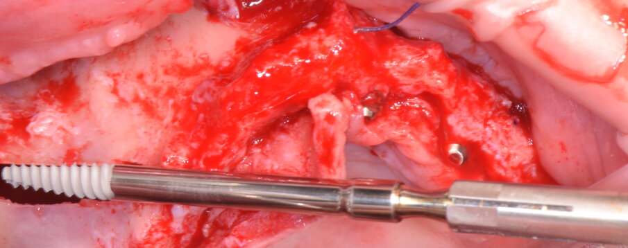 Figg. 24-26 - Inserimento implantare in emiarcata destra.