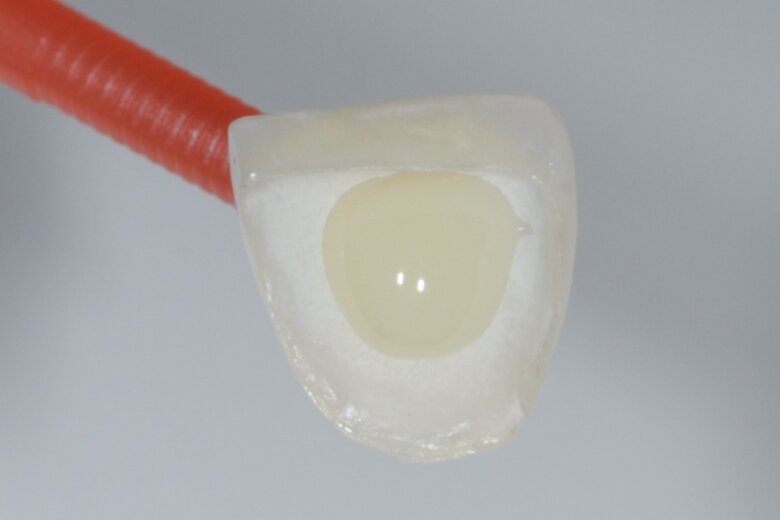 Fig. 19 PANAVIA V5 Paste applied to the inner surface of the veneer.