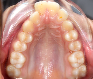 Fig 7a: Pretreatment intraoral view showing severe transverse and anteroposterior jaw discrepancy