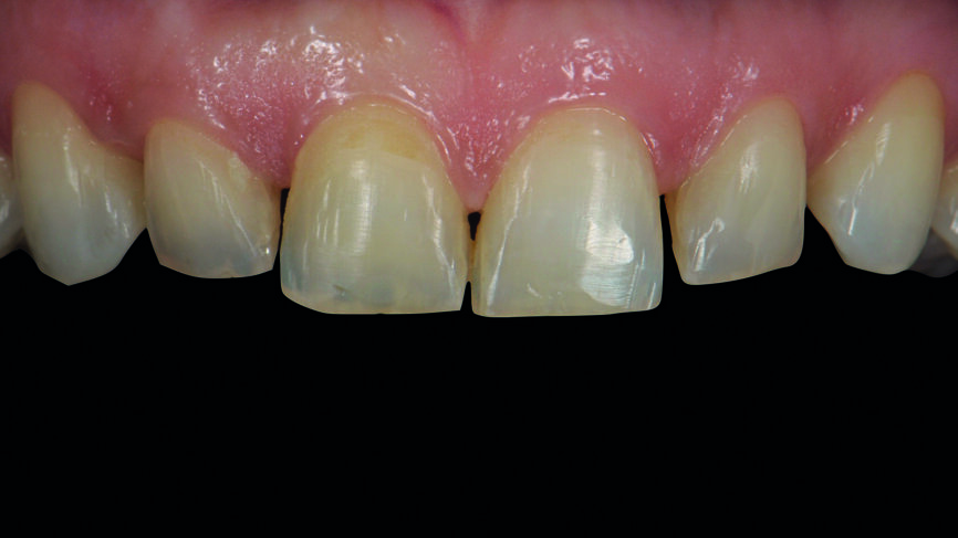 Fig. 2a : Dents antérieures après le traitement orthodontique.
