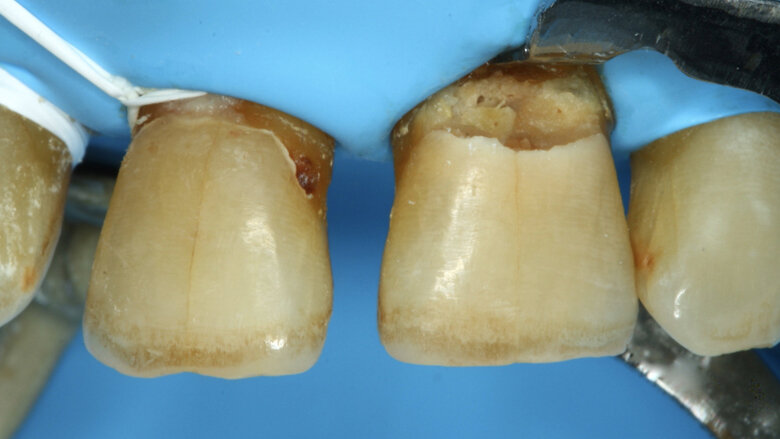 Figuras 2 y 3. Se colocan dos hilos retractores 000 y 00 Ultrapack y aislamiento absoluto con hilo dental tipo teflón y un clamp para dientes anteriores debido a que la lesión se extiende infra-gingivalmente.