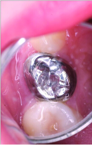 Figure 8: The Hall technique: Immediate post op: The SSC is fully cemented on tooth 54. The excess cement is removed.  Some blanching is noticed buccally and palatally. This disappears within the hour.