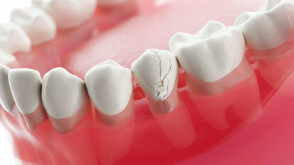 S2k-Leitlinie zur Versorgung dentaler Traumata aktualisiert