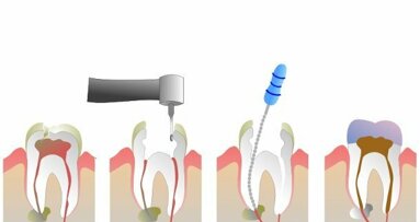 Une nouvelle procédure dentaire pourrait remplacer le traitement endodontique