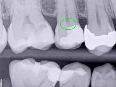Fig. 2: Six-month follow-up radiograph showing a thick dentinal bridge under the pulp capping.