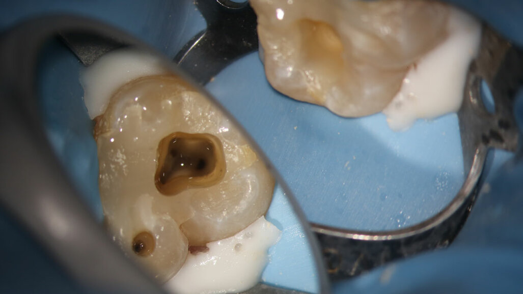 Principle-driven endodontics: Proven case results