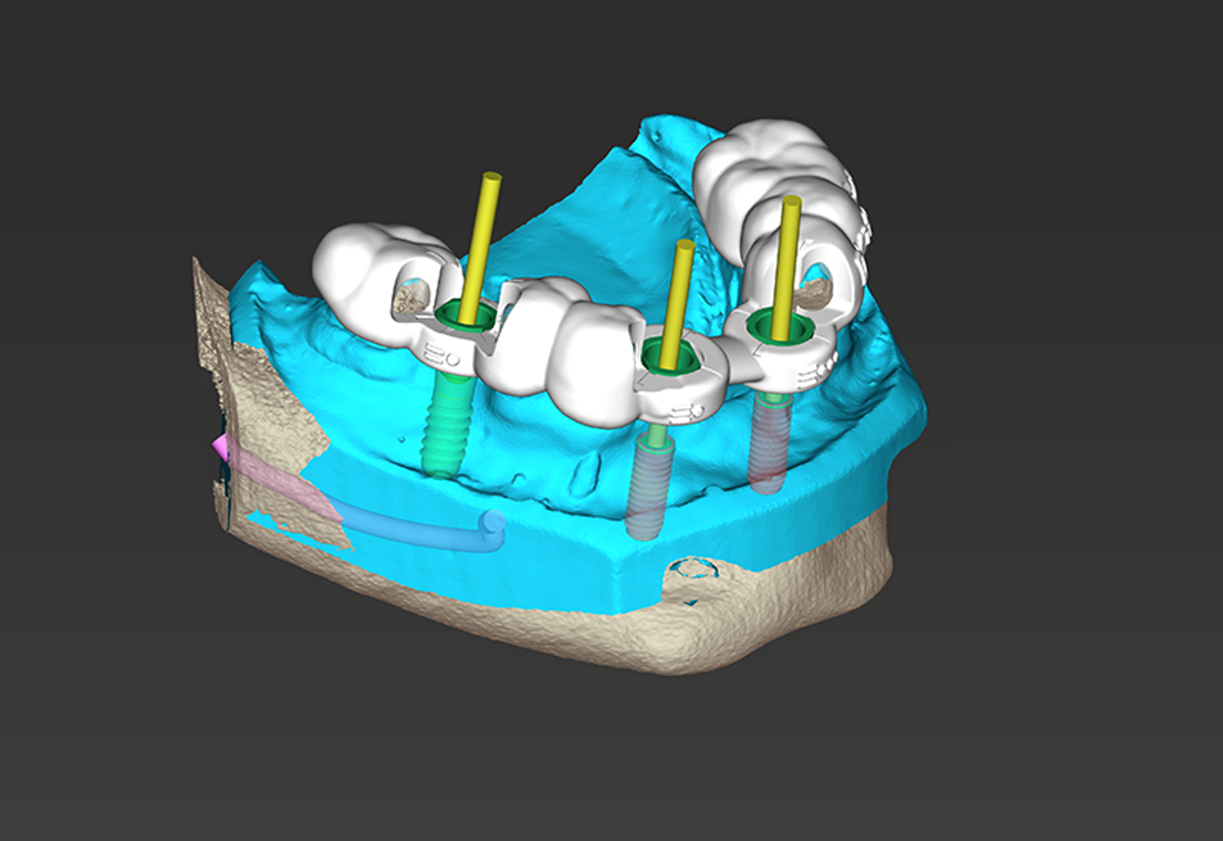 Dental Wings coDiagnostiX™ Implant Planning Software