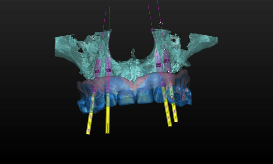 Fig. 3: Implant treatment planning in Simplant using the dual-scan protocol to visualise tooth position as well as abutment position. Four DS PrimeTaper implants were planned for immediate restoration.