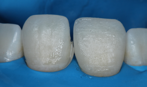 Fig. 9: 1st tooth completed