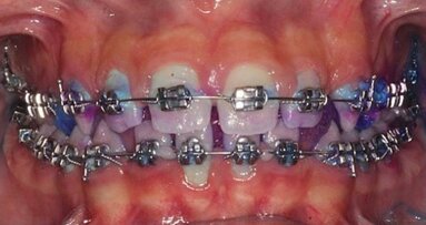 La terapia proattiva nel mantenimento del paziente ortodontico parodontale