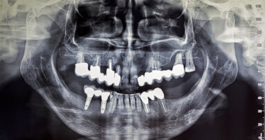 Reduced radiation dose in maxillofacial radiology yields comparable diagnostic results, study says