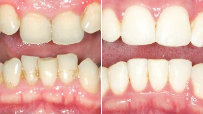 Gerade Zähne in sechs Monaten: Online-Fortbildung erklärt erfolgreiches Konzept