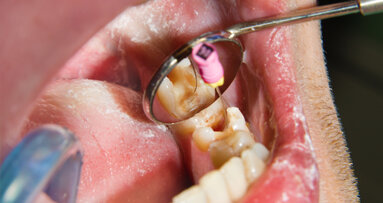 Specialised endodontic care remains challenge, FDI survey says