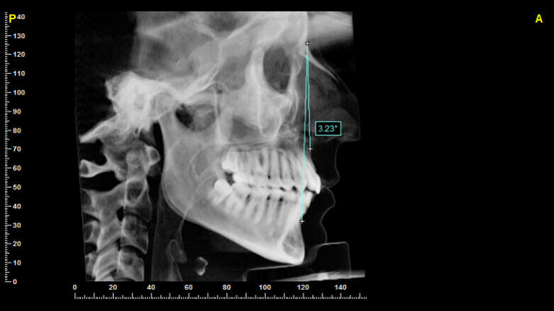 Ruolo della posizione degli incisivi nella preparazione ortodontica pre-chirurgica