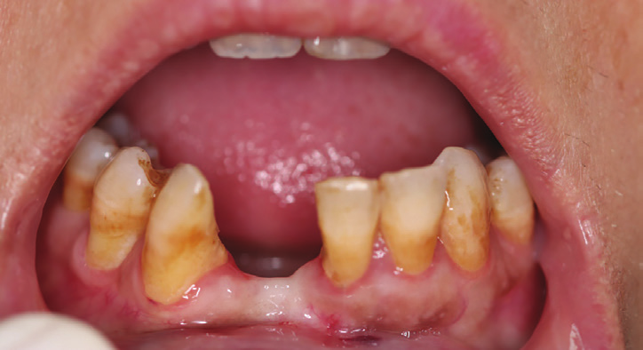 Figure 2: Intraoral view showing the extended bone and gingival loss with recession on both central incisor and canine.