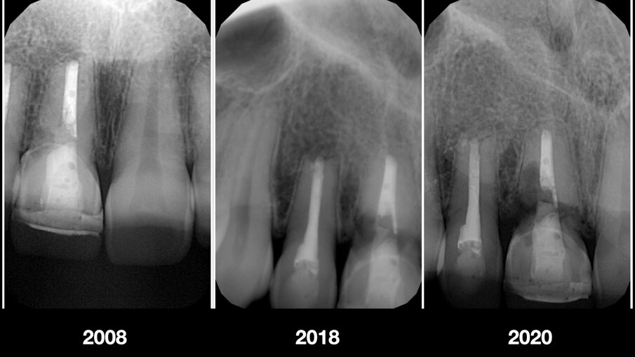 Fig. 5_Radiografie intraorali iniziali.