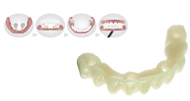 Il ponte Immediate Smile® offre a pazienti e dentisti qualcosa per cui sorridere
